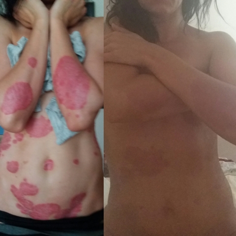 liječenje naftal 2